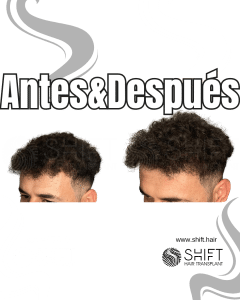 Antes y después de una micropigmentación capilar para un camuflaje de densidad en Turquía en SHIFT Hair en Estambul 88 3