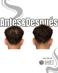 Antes y después de una micropigmentación capilar para un camuflaje de densidad en Turquía en SHIFT Hair en Estambul 90 3