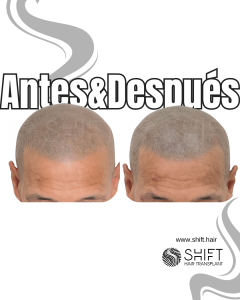Antes y después de una micropigmentación capilar para un look afeitado en Turquía en SHIFT Hair en Estambul 22 3
