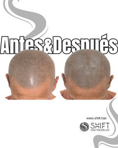 Antes y después de una micropigmentación capilar para un look afeitado en Turquía en SHIFT Hair en Estambul 23 3