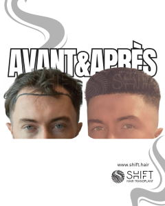 Avant Après de Greffe de Cheveux pour Calvitie Norwood 3 en Turquie chez SHIFT Hair à Istanbul 30 3