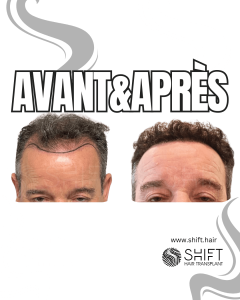 Avant Après de Greffe de Cheveux pour Calvitie Norwood 4 en Turquie chez SHIFT Hair à Istanbul 26 3