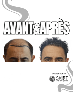 Avant Après de Greffe de Cheveux pour Calvitie Norwood 7 en Turquie chez SHIFT Hair à Istanbul 23 3