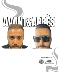 Avant Après de la greffe de cheveux de modèle féminin en Turquie chez SHIFT Hair à Istanbul 04 3