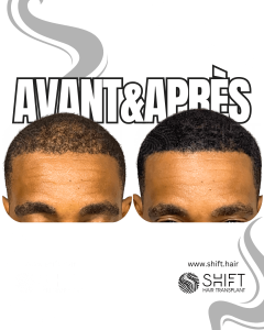 Avant Après de la micropigmentation du cuir chevelu pour le camouflage de densité en Turquie chez SHIFT Hair à Istanbul 76 3