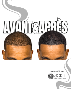 Avant Après de la micropigmentation du cuir chevelu pour le camouflage de densité en Turquie chez SHIFT Hair à Istanbul 77 3