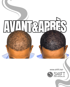 Avant Après de la micropigmentation du cuir chevelu pour le camouflage de densité en Turquie chez SHIFT Hair à Istanbul 78 3
