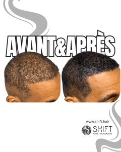 Avant Après de la micropigmentation du cuir chevelu pour le camouflage de densité en Turquie chez SHIFT Hair à Istanbul 79 3