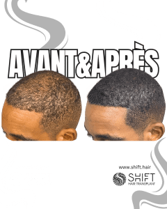 Avant Après de la micropigmentation du cuir chevelu pour le camouflage de densité en Turquie chez SHIFT Hair à Istanbul 80 3
