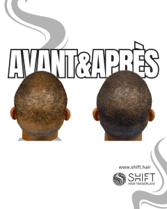Avant Après de la micropigmentation du cuir chevelu pour le camouflage de densité en Turquie chez SHIFT Hair à Istanbul 81 3