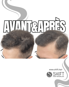 Avant Après de la micropigmentation du cuir chevelu pour le camouflage de densité en Turquie chez SHIFT Hair à Istanbul 85 3