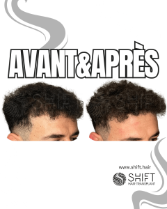 Avant Après de la micropigmentation du cuir chevelu pour le camouflage de densité en Turquie chez SHIFT Hair à Istanbul 87 3