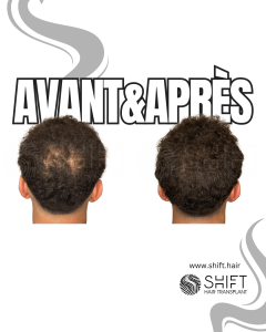 Avant Après de la micropigmentation du cuir chevelu pour le camouflage de densité en Turquie chez SHIFT Hair à Istanbul 89 3