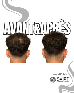 Avant Après de la micropigmentation du cuir chevelu pour le camouflage de densité en Turquie chez SHIFT Hair à Istanbul 90 3