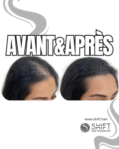 Avant Après de la micropigmentation du cuir chevelu pour les femmes pour le camouflage de densité en Turquie chez SHIFT Hair à Istanbul 20 3
