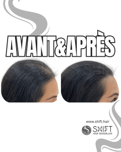 Avant Après de la micropigmentation du cuir chevelu pour les femmes pour le camouflage de densité en Turquie chez SHIFT Hair à Istanbul 22 3