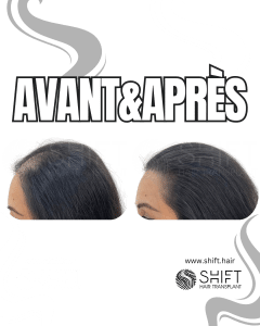 Avant Après de la micropigmentation du cuir chevelu pour les femmes pour le camouflage de densité en Turquie chez SHIFT Hair à Istanbul 23 3