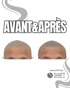 Avant Après de la micropigmentation du cuir chevelu pour un look rasé en Turquie chez SHIFT Hair à Istanbul 21 3
