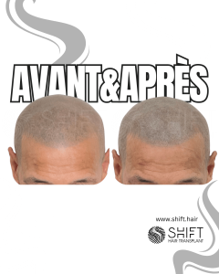 Avant Après de la micropigmentation du cuir chevelu pour un look rasé en Turquie chez SHIFT Hair à Istanbul 22 3