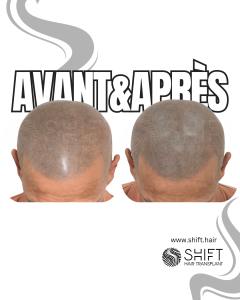 Avant Après de la micropigmentation du cuir chevelu pour un look rasé en Turquie chez SHIFT Hair à Istanbul 23 3