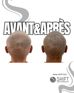 Avant Après de la micropigmentation du cuir chevelu pour un look rasé en Turquie chez SHIFT Hair à Istanbul 24 3