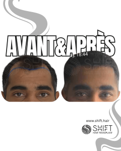 Avant Après une greffe de cheveux afro en Turquie chez SHIFT Hair à Istanbul 40 3