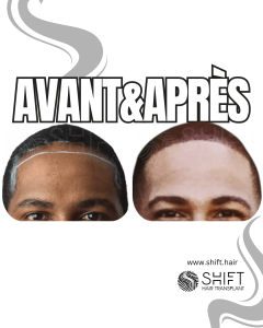 Avant Après une greffe de cheveux afro en Turquie chez SHIFT Hair à Istanbul 41 3