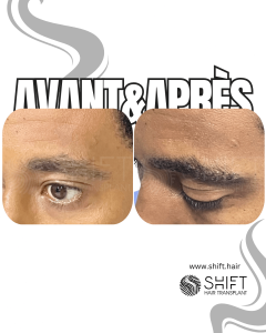 Avant Après une greffe de sourcil pour hommes en Turquie chez SHIFT Hair à Istanbul 03 3
