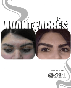 Avant Après une greffe de sourcils en Turquie chez SHIFT Hair à Istanbul 27 3