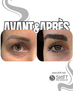 Avant Après une greffe de sourcils en Turquie chez SHIFT Hair à Istanbul 29 3