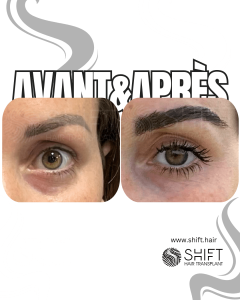 Avant Après une greffe de sourcils en Turquie chez SHIFT Hair à Istanbul 30 3