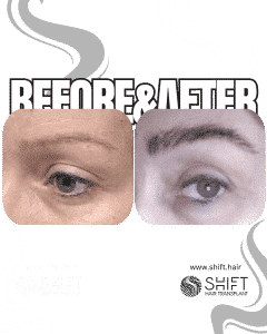 Eyebrow Transplant Turkey Before After SHIFT Hair Transplant in Istanbul 28 3
