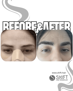 Eyebrow Transplant Turkey Before After SHIFT Hair Transplant in Istanbul 29 3
