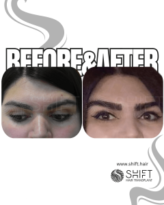 Eyebrow Transplant Turkey Before After SHIFT Hair Transplant in Istanbul 30 3