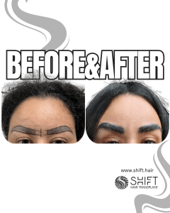 Eyebrow Transplant Turkey Before After SHIFT Hair Transplant in Istanbul 31 3