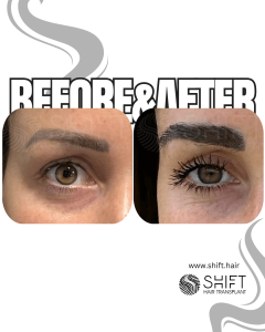 Eyebrow Transplant Turkey Before After SHIFT Hair Transplant in Istanbul 32 3