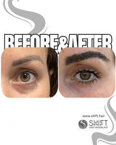 Eyebrow Transplant Turkey Before After SHIFT Hair Transplant in Istanbul 33 3