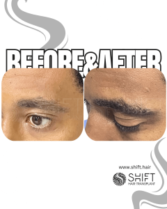 Eyebrow Transplant for Men Turkey Before After SHIFT Hair Transplant in Istanbul 03 3