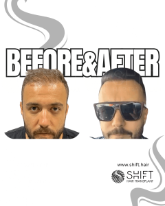 Female Pattern Hair Transplant Turkey Before After SHIFT Hair Transplant in Istanbul 04 3