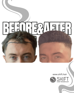 Hair Transplant Turkey Before After Norwood 3 Baldness SHIFT Hair Transplant in Istanbul 30 3