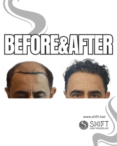 Hair Transplant Turkey Before After Norwood 7 Baldness SHIFT Hair Transplant in Istanbul 22 3