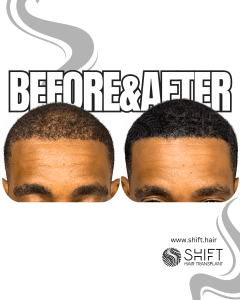 Scalp Micropigmentation for Density Camouflage Turkey Before After SHIFT Hair Transplant in Istanbul 77 3