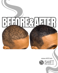 Scalp Micropigmentation for Density Camouflage Turkey Before After SHIFT Hair Transplant in Istanbul 80 3