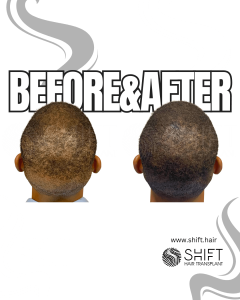 Scalp Micropigmentation for Density Camouflage Turkey Before After SHIFT Hair Transplant in Istanbul 82 3