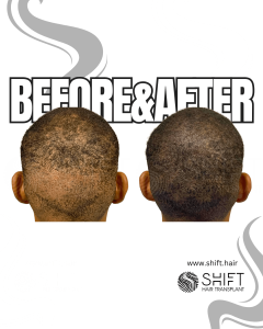 Scalp Micropigmentation for Density Camouflage Turkey Before After SHIFT Hair Transplant in Istanbul 83 3