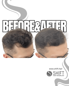 Scalp Micropigmentation for Density Camouflage Turkey Before After SHIFT Hair Transplant in Istanbul 85 3
