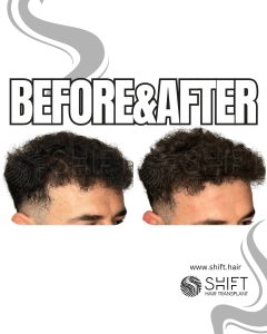 Scalp Micropigmentation for Density Camouflage Turkey Before After SHIFT Hair Transplant in Istanbul 87 3