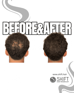 Scalp Micropigmentation for Density Camouflage Turkey Before After SHIFT Hair Transplant in Istanbul 89 3
