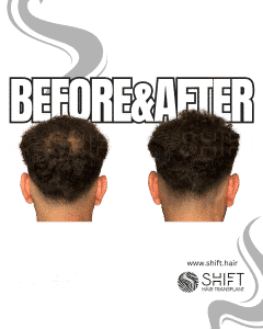 Scalp Micropigmentation for Density Camouflage Turkey Before After SHIFT Hair Transplant in Istanbul 90 3