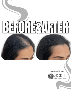 Scalp Micropigmentation for Density Camouflage for Women Turkey Before After SHIFT Hair Transplant in Istanbul 20 3